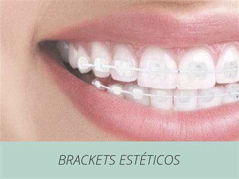 brackets metalicos esteticos|brackets invisibles precio.